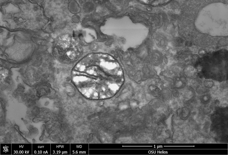 cnidarian Henneguya salminicola parasite without a mitochondrial genome
